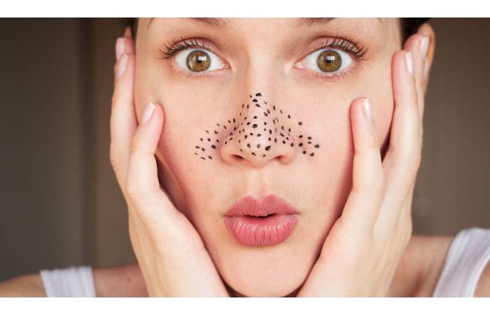 Blackheads Write For Us